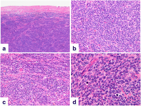 Rapid growth of mitotically active cellular fibroma of the ovary: a ...