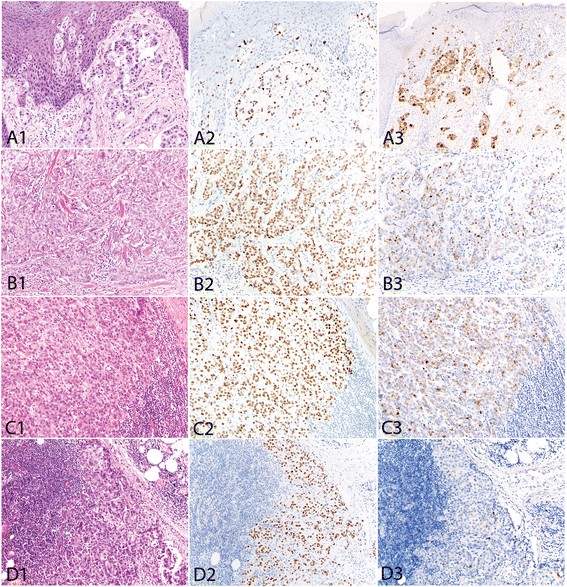 GATA3 is a sensitive marker for primary genital extramammary paget