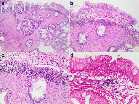 Colonic Perineurioma (benign Fibroblastic Polyp): Case Report And ...