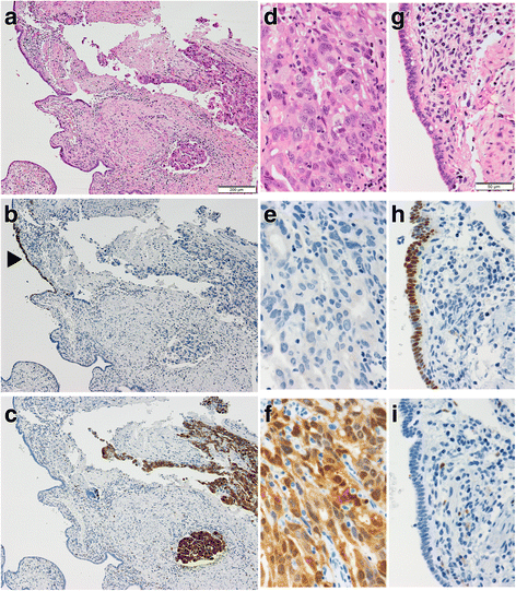 High-grade serous carcinoma with discordant p53 signature: report of a ...