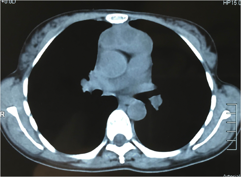 Thymoma and thymic carcinoma associated with multilocular thymic cyst