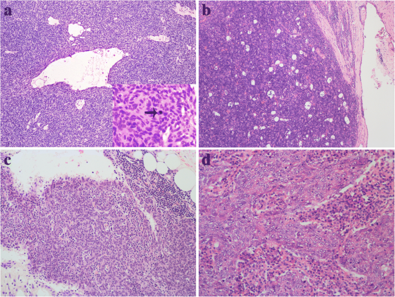 Thymoma and thymic carcinoma associated with multilocular thymic cyst a clinicopathologic
