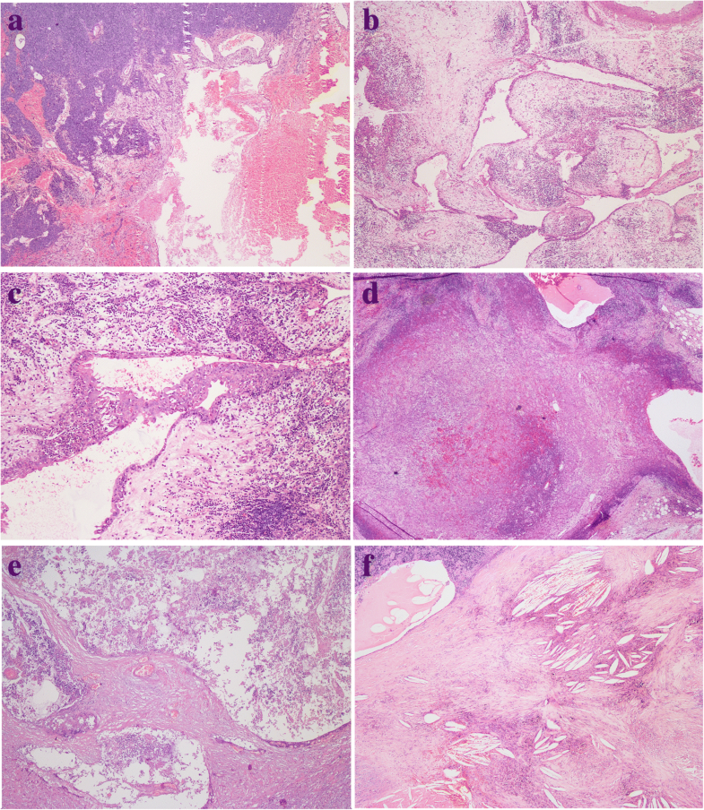 Thymoma and thymic carcinoma associated with multilocular thymic cyst a clinicopathologic