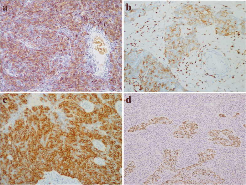 Thymoma and thymic carcinoma associated with multilocular thymic cyst