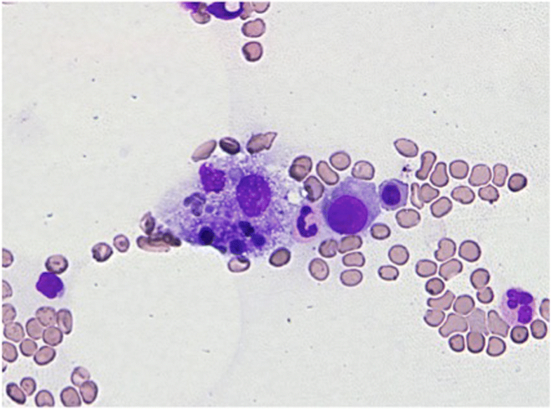 Pure intravascular recurrence of CD5positive diffuse large Bcell
