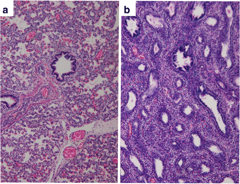 An autopsy case of epignathus (immature teratoma of the soft palate ...