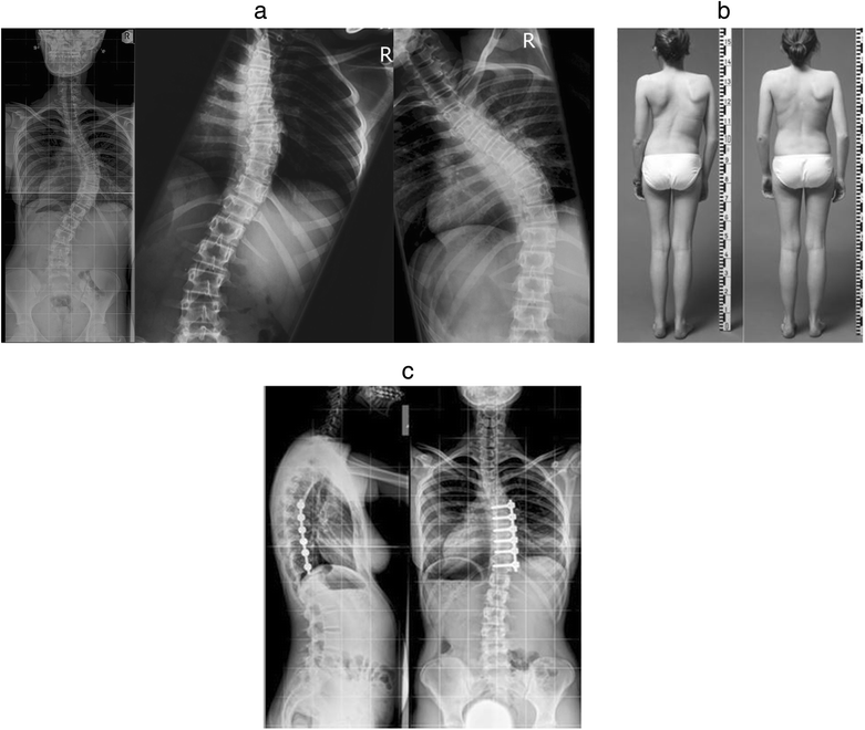 “BoneοnBone” surgical reconstruction of moderate severity, flexible single curve adolescent