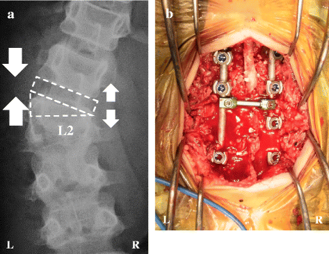 Asymmetrical pedicle subtraction osteotomy for progressive
