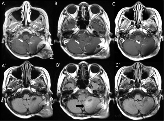 A case of radiation-induced osteosarcoma treated ...