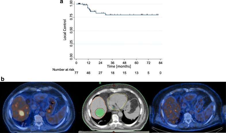 Phase Ii Trial On Sbrt For Unresectable Liver Metastases Long Term Outcome And Prognostic 6520