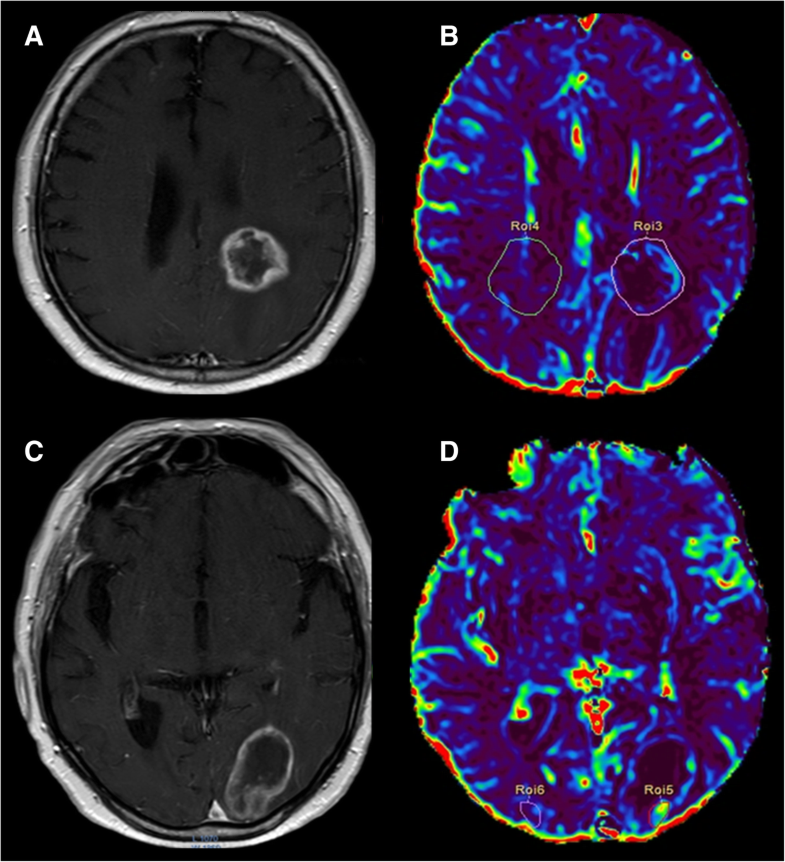 DCE and DSC perfusion MRI diagnostic accuracy in the followup of