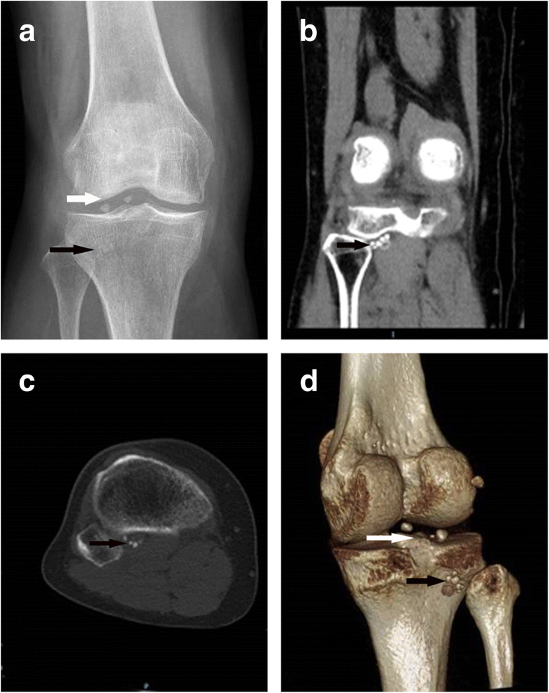Arthroscopic removal of loose bodies using the accessory portals in the difficult locations of