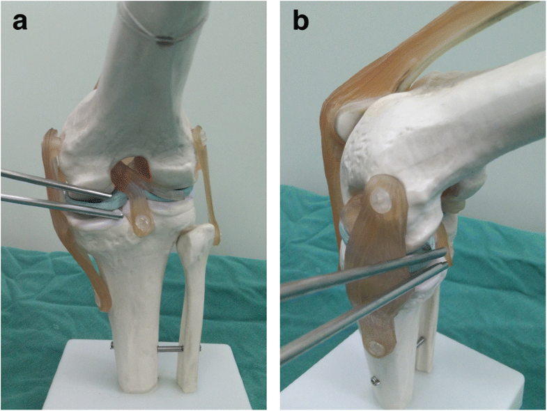 Arthroscopic removal of loose bodies using the accessory portals in the ...