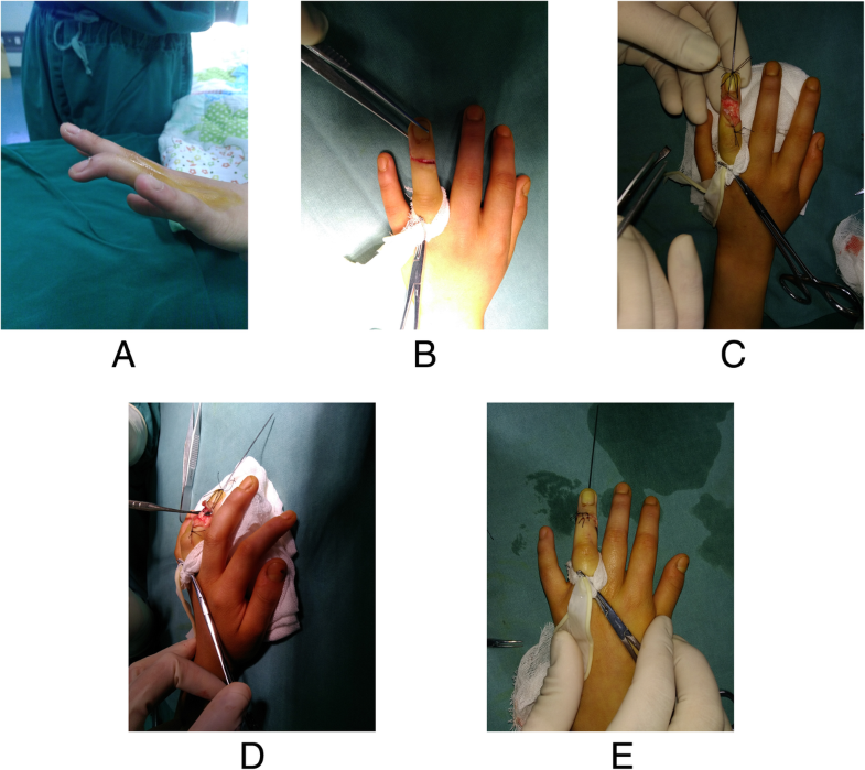 Scar overlapping suture for treating chronic tendinous mallet finger in