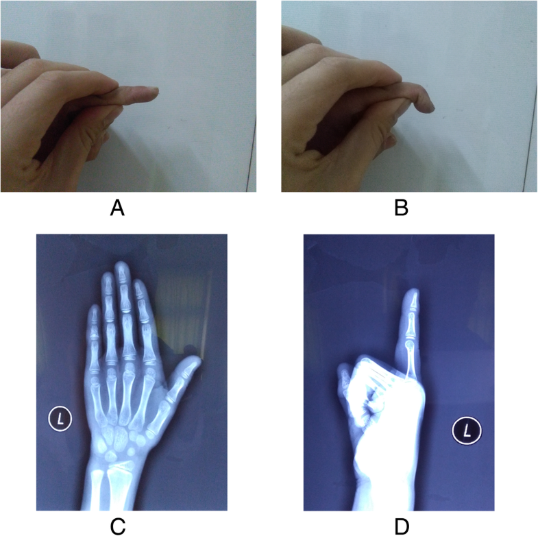 Scar overlapping suture for treating chronic tendinous mallet finger in