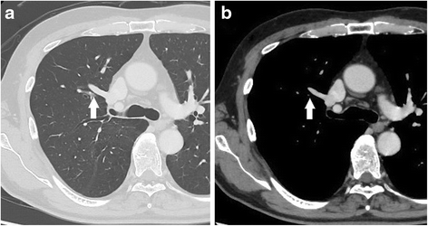 Thoracoscopic lobectomy for lung cancer in a patient with a partial ...