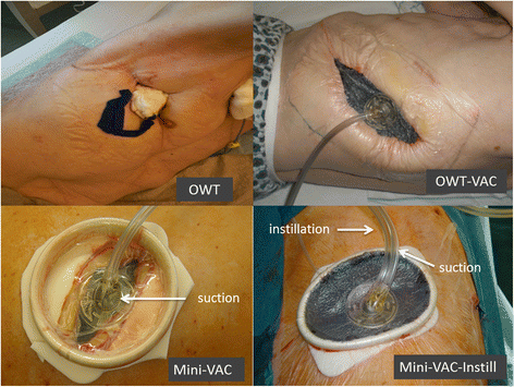 short term and long term outcomes of intrathoracic vacuum therapy of