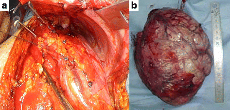 and occupied approximately half of the left pleural cavity