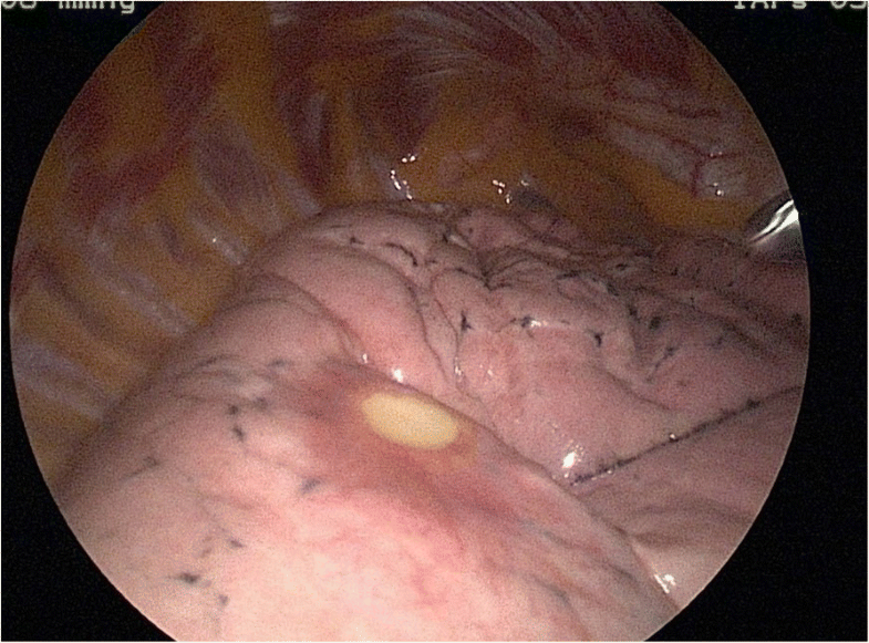 A rare case of human pulmonary dirofilariasis with nodules mimicking