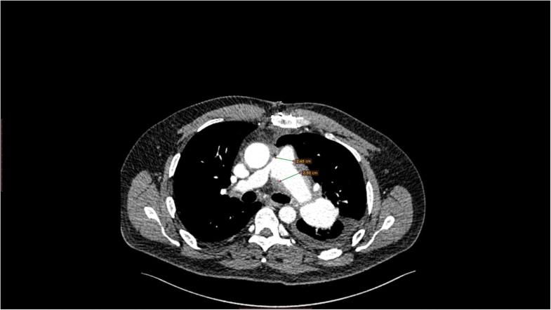 Case report and management approach in idiopathic pulmonary arteries aneurysm | Journal of ...