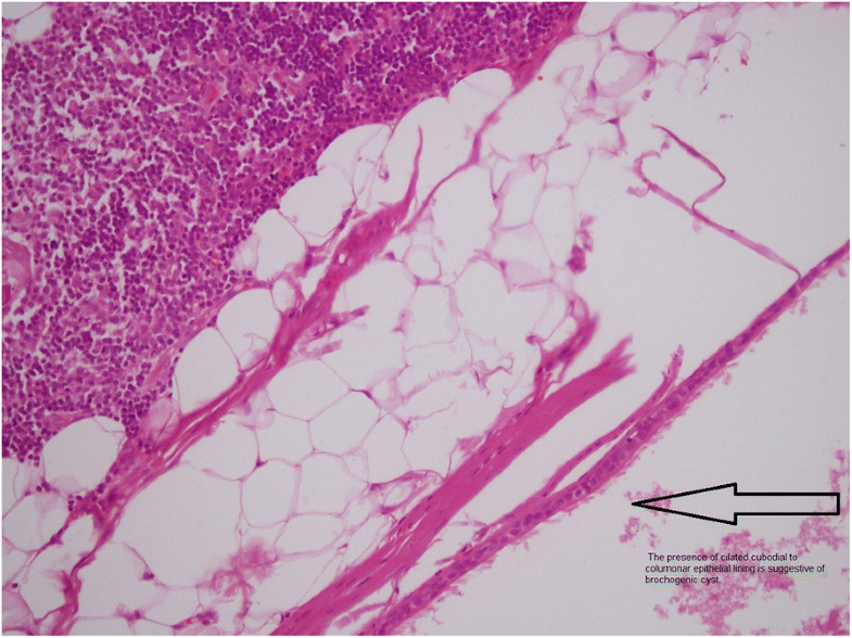 Intrathymic bronchogenic cyst an extremely rare tumor of anterior