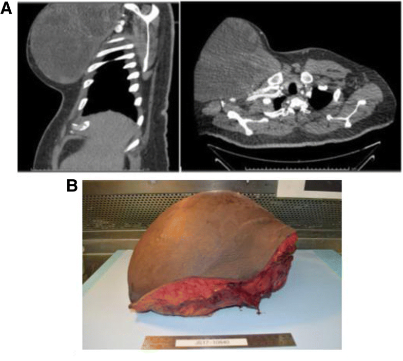 R0 Resection And Reconstruction For A Large Rapidly Progressive Chest