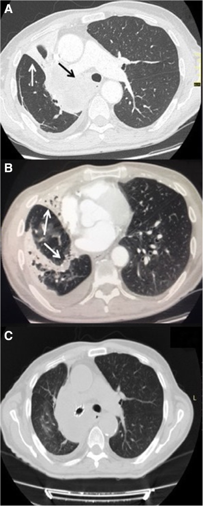 Endoscopic central airway recanalization to enable first line