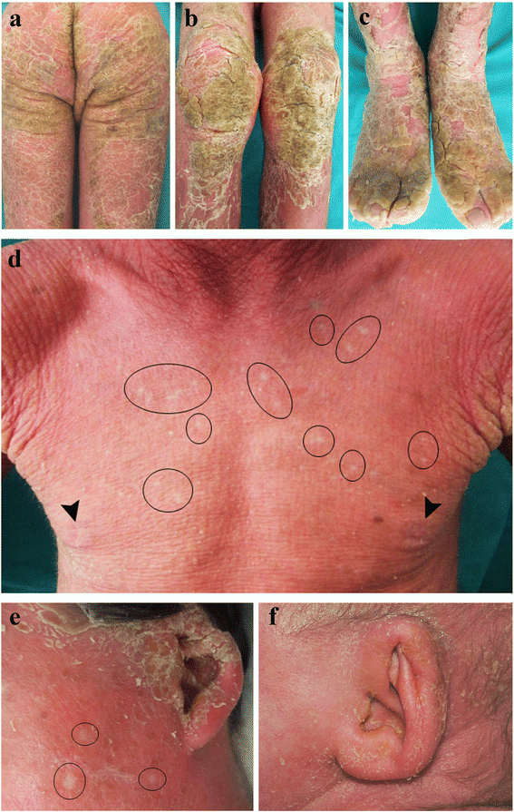 Ichthyosis with confetti clinics, molecular and management