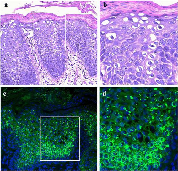 Ichthyosis with confetti clinics, molecular and management