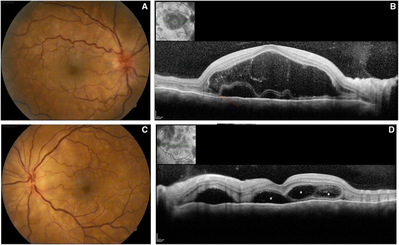 Vogt-Koyanagi-Harada disease: review of a rare autoimmune disease