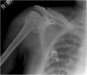 Proximal humerus derotational osteotomy for internal rotation ...