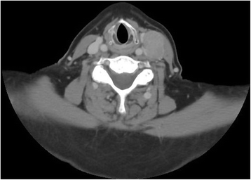 Papillary thyroid cancer recurrence 43 Years following Total ...