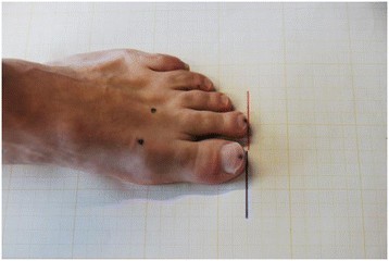 Intra-observer reliability for measuring first and second toe and ...