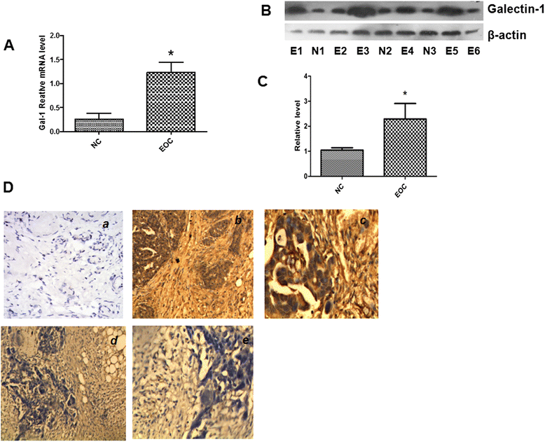 clinical implication of the serum galectin 1 expression in