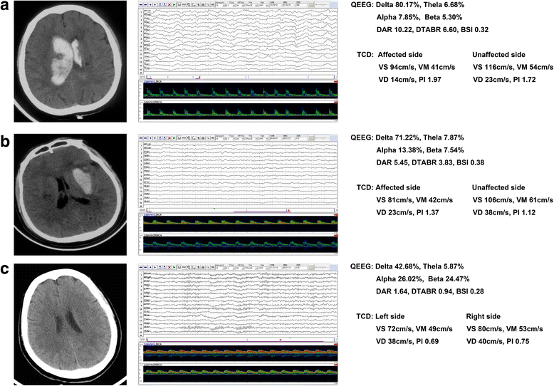 Transcranial Doppler combined with quantitative EEG brain function ...