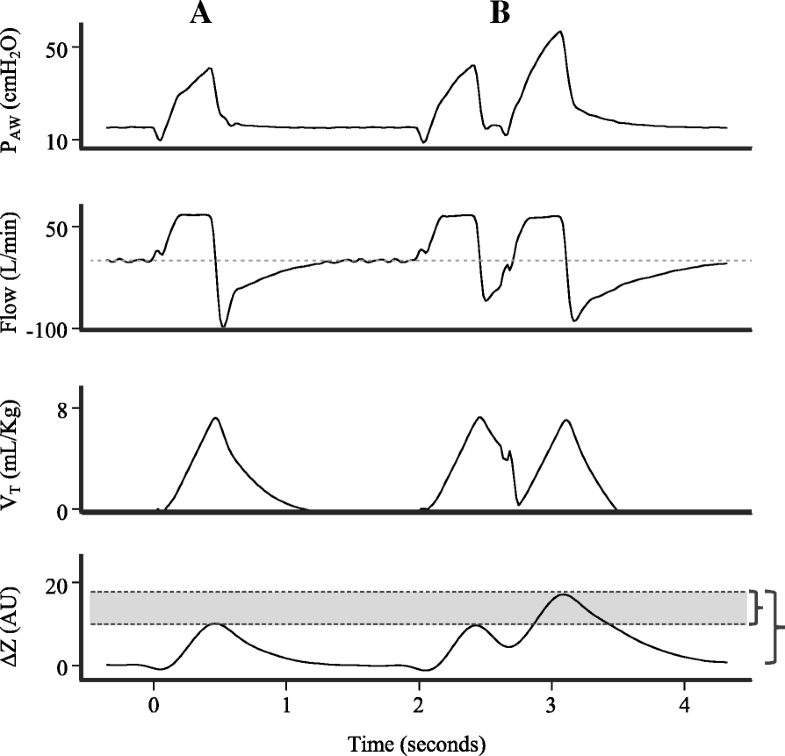 Electrical Impedance Tomography In Acute Respiratory Distress Syndrome 