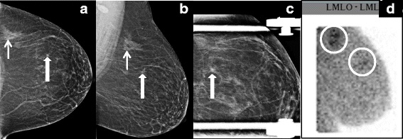 lobular-breast-cancer-series-imaging-breast-cancer-research-full-text