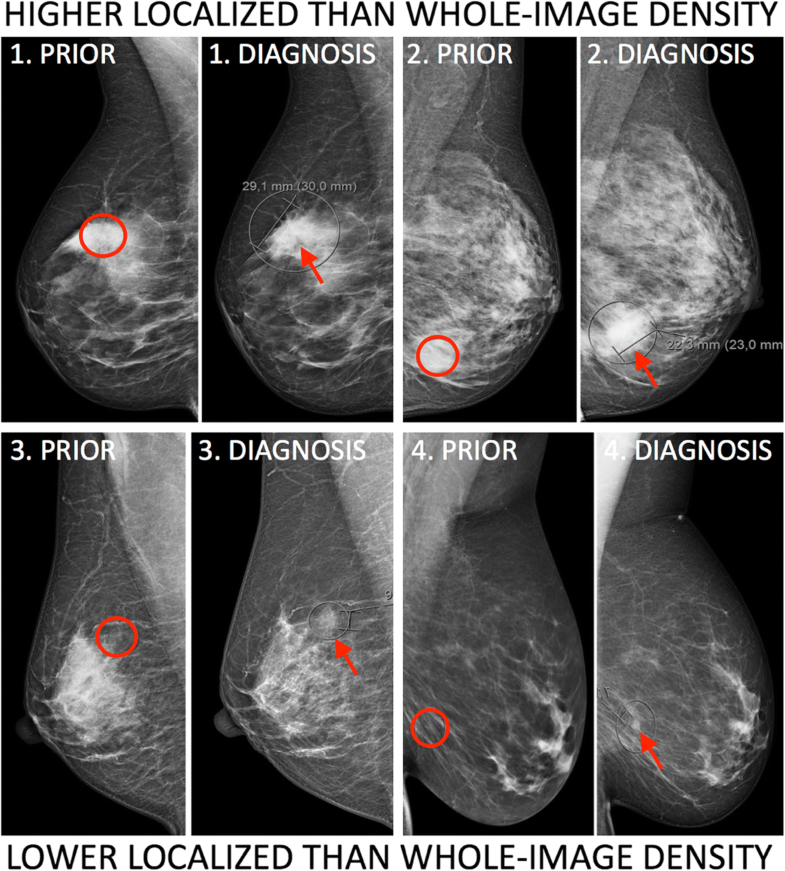 Localized mammographic density is associated with interval cancer and
