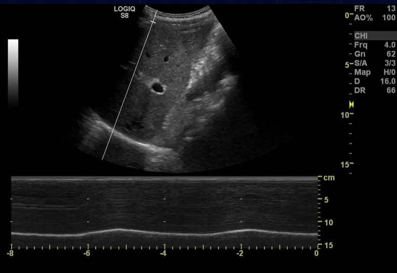 The Area method a new method for ultrasound assessment of