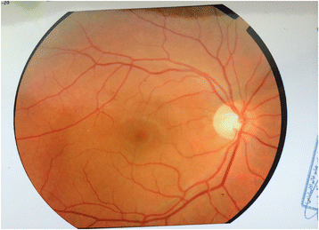 Valsalva Retinopathy In Pregnancy A Case Report Valsalva Retinopathy In Pregnancy A Case Report