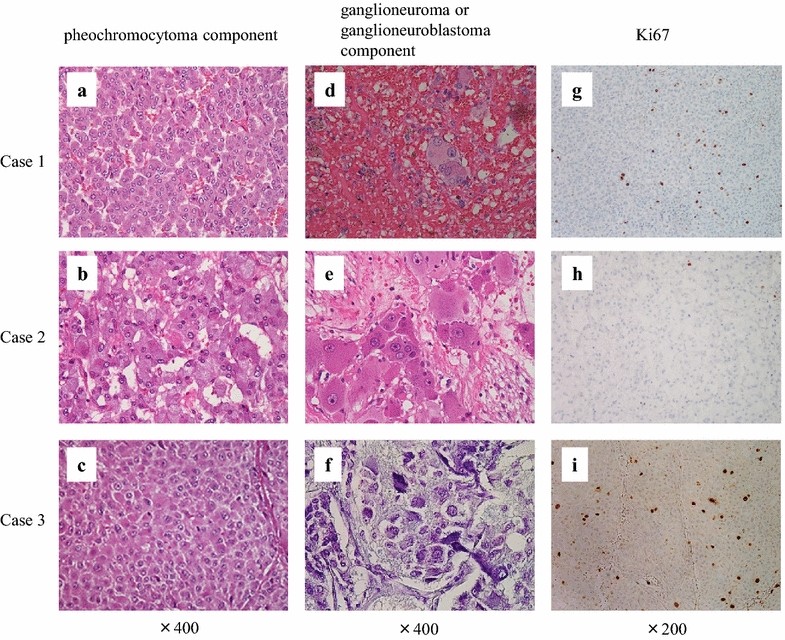 Composite Pheochromocytoma Of The Adrenal Gland A Case Series Bmc Research Notes Full Text 4895