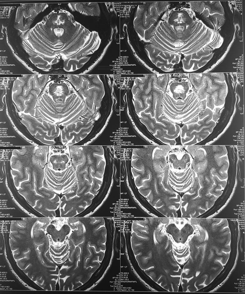 Tongue fasciculations with denervation pattern in osmotic demyelination