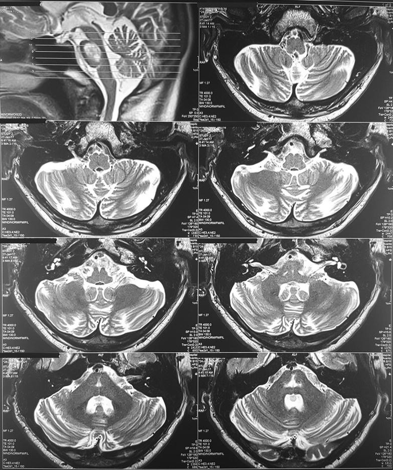 Tongue fasciculations with denervation pattern in osmotic demyelination