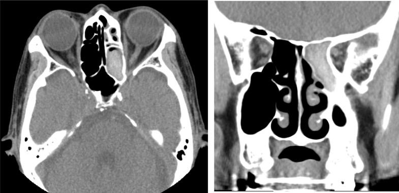 Sinobronchial allergic mycosis syndrome in an elderly male | Allergy ...