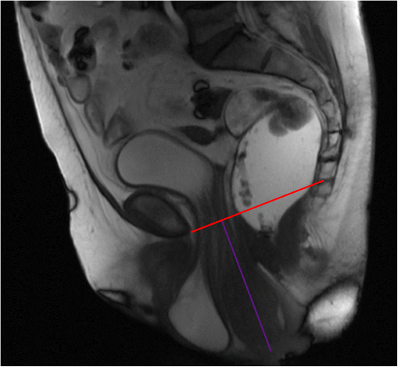 Dynamic Magnetic Resonance Imaging Of The Female Pelvic Floor—a