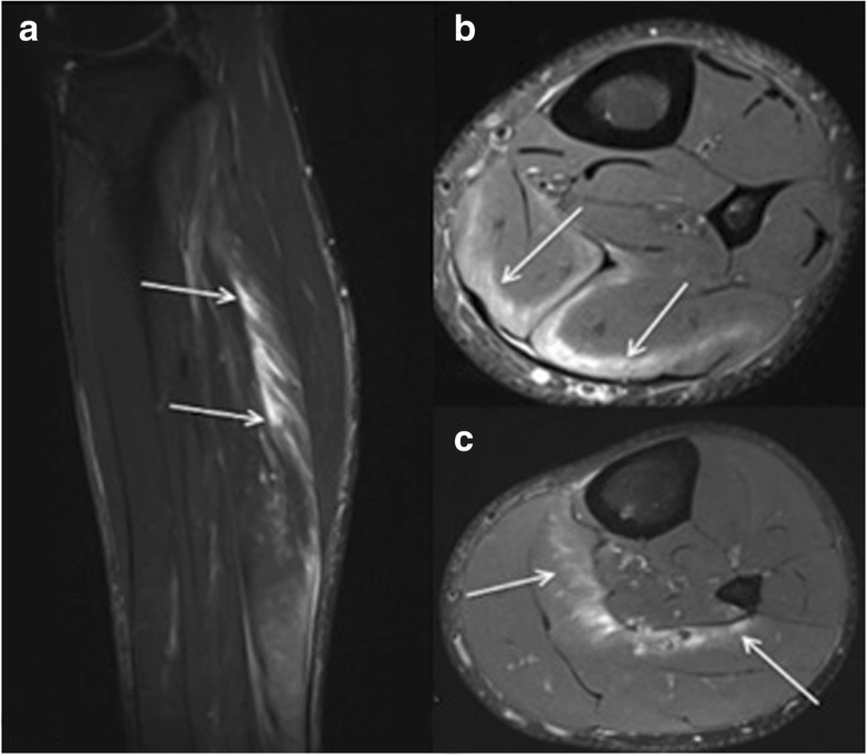Imaging of hip and thigh muscle injury a pictorial review Insights