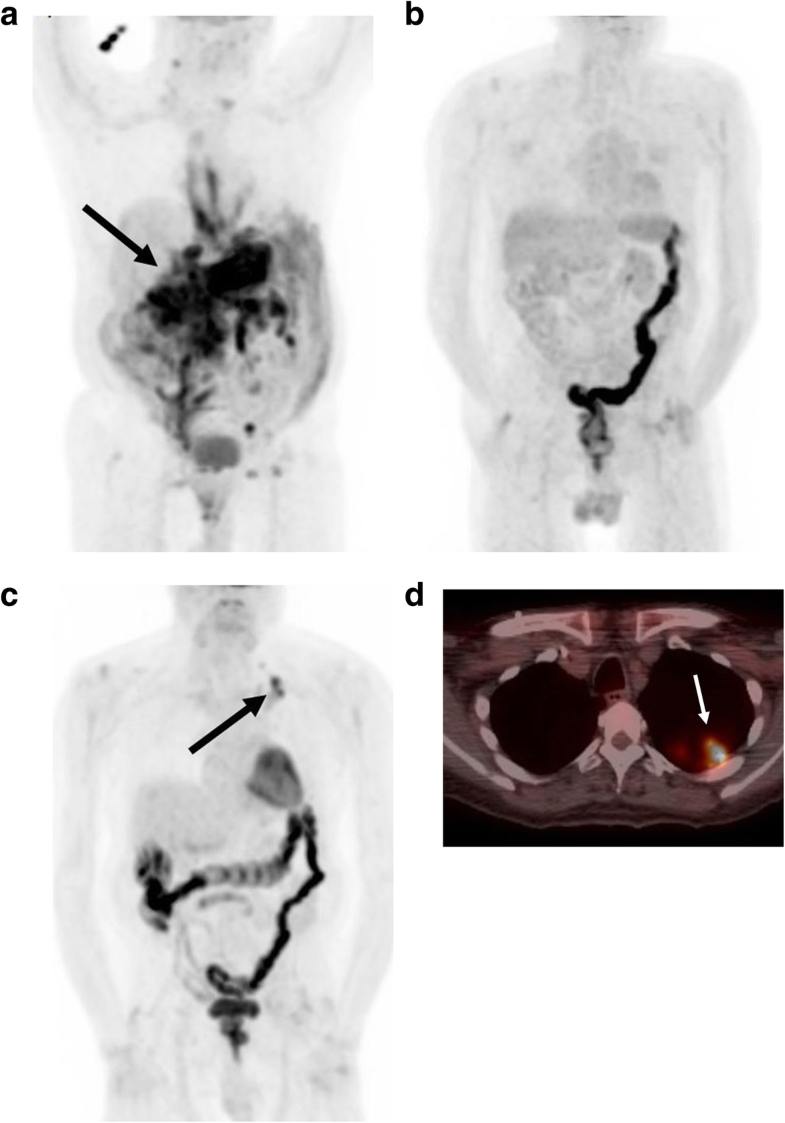 An Update On Burkitt Lymphoma A Review Of Pathogenesis And Multimodality Imaging Assessment Of 4369