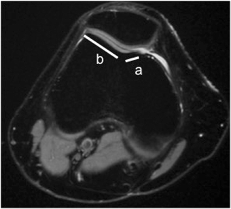 Patellar maltracking an update on the diagnosis and treatment