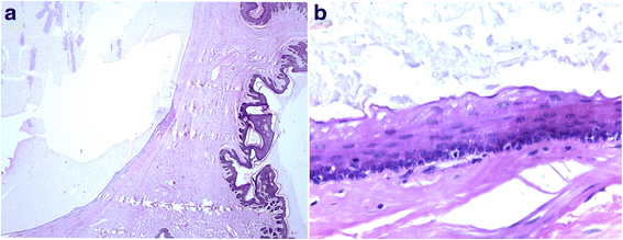 Steatocystoma Simplex In Penile Foreskin A Case Report Journal Of
