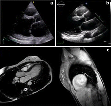 Presymptomatic diagnosis of Fabry’s disease: a case report | Journal of Medical Case Reports ...